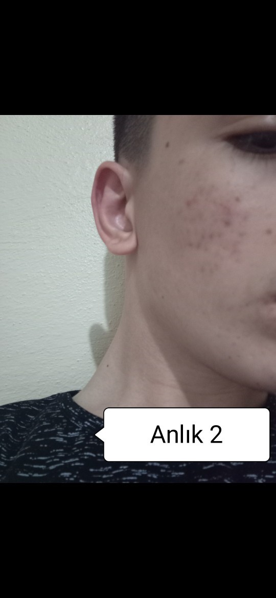 Akne için resimlere bakar mısınız?