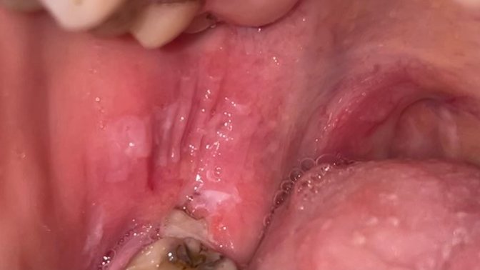 Diş hekimi olan var mı ACİL çok şiddetli ağrım var bu yanakta enf. Mu oluşmuş yoksa 20 lik dişin yaptığı ağrı sonucu mu olmuş?