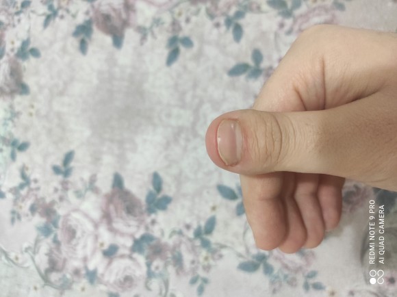 Tırnaklarım yüzünden utanıyorum. Ne yapmalıyım?