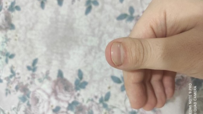 Tırnaklarım yüzünden utanıyorum. Ne yapmalıyım?