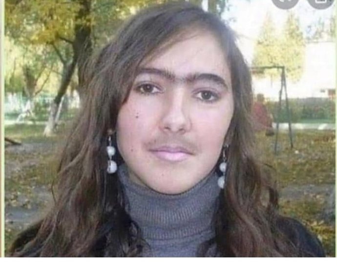 Yüz tüylerim çok hızlı uzuyor?