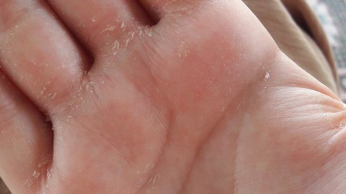 Ellerim böyle oldu. Sebebi nedir? 