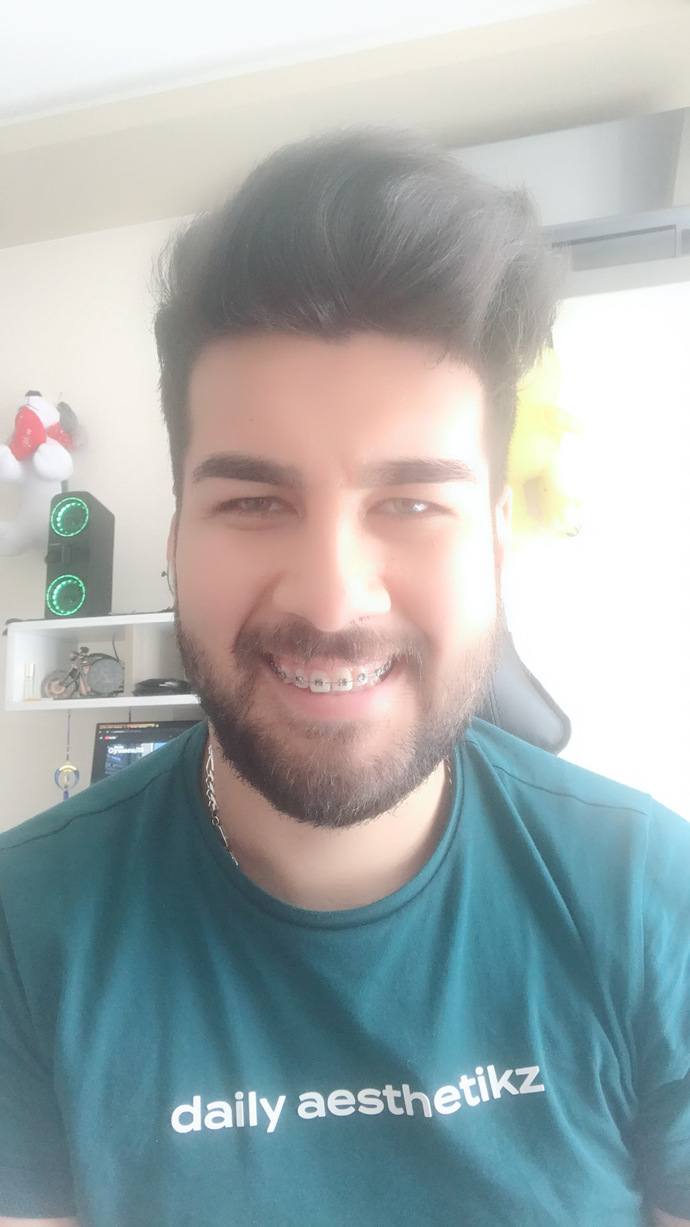 Diş teli taktırdım. Diş teli güzelliği/yakışıklılığı gölgeler mi?