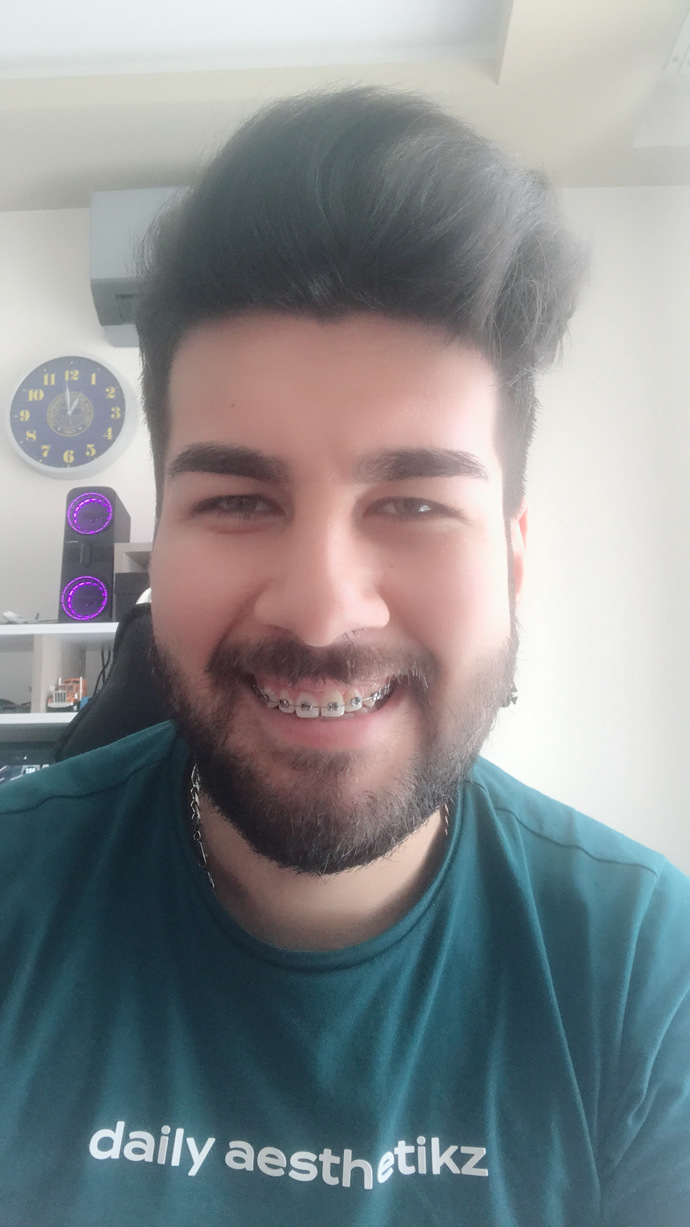 Diş teli taktırdım. Diş teli güzelliği/yakışıklılığı gölgeler mi?