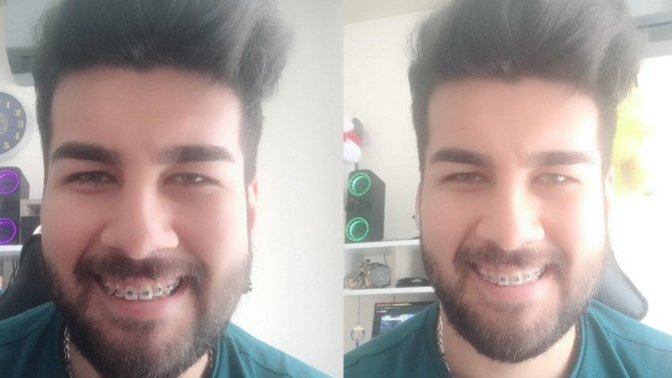 Diş teli taktırdım. Diş teli güzelliği/yakışıklılığı gölgeler mi? 