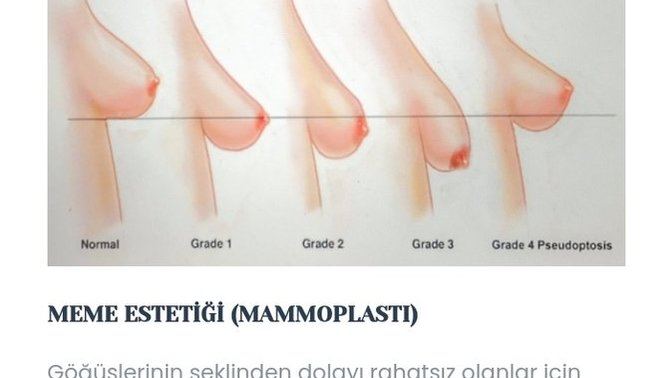 Göğüslerim sarkık mı böyle olunca?