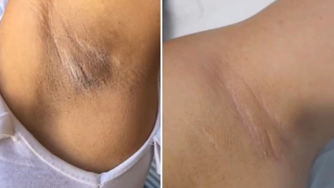 Koltuk altı, genital bölgedeki kararmaları yok eden bir krem sizce zararlı mıdır almalı mıyım?