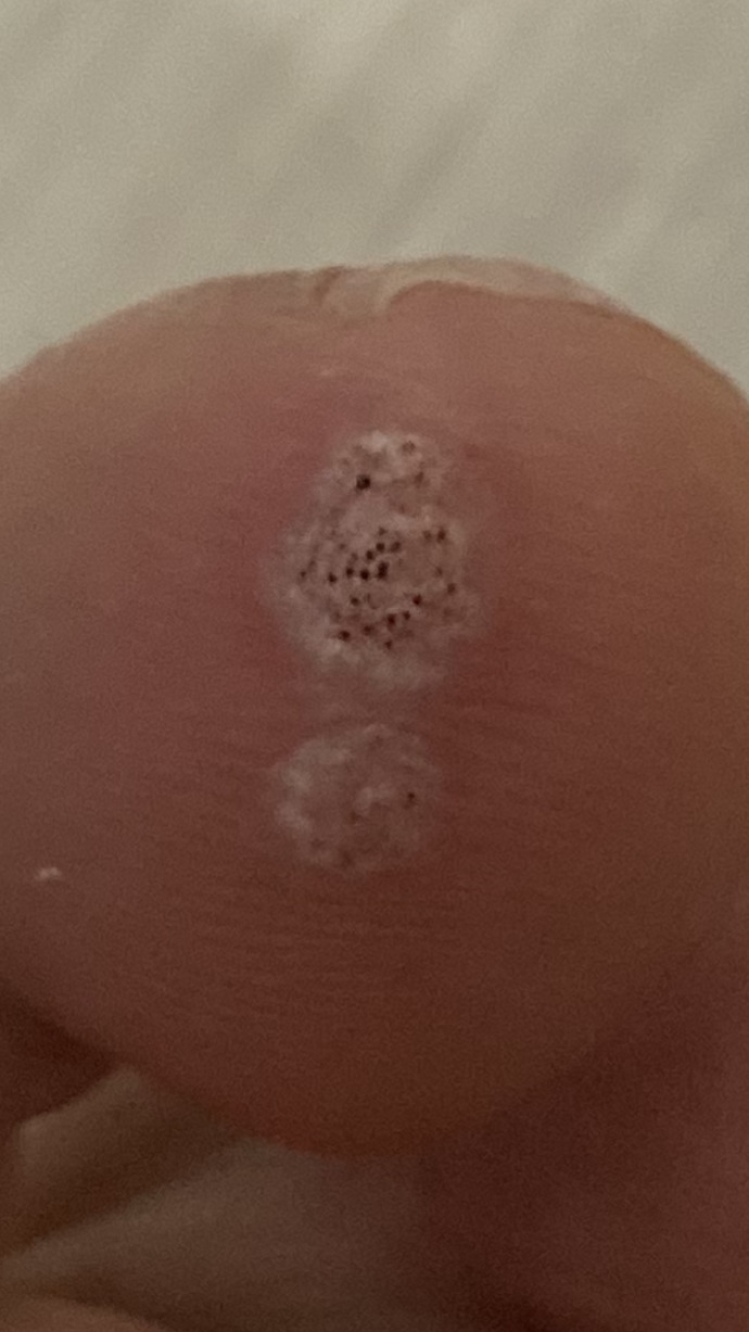 Siğilin geçtiğini ya da çoğaldığını nasıl anlarım?
