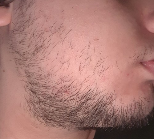 Merhaba Hayırlı Sabahlar Sakallarım Ve Bıyığım Nasıl Sizce Çok Köselik Azlık Yani Var mı? Yanaklarım Nasıl çenem gibi Olur?