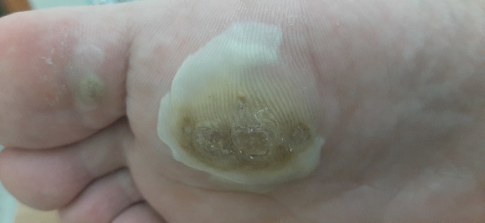 Arkadaşlar ayağımda böyle birşey çıktı doktor krem yazdı 7 gün kullandım etrafı bembeyaz oldu nedir şimdiden teşekkür ederim?