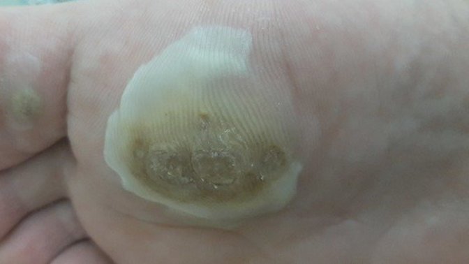 Arkadaşlar ayağımda böyle birşey çıktı doktor krem yazdı 7 gün kullandım etrafı bembeyaz oldu nedir şimdiden teşekkür ederim?