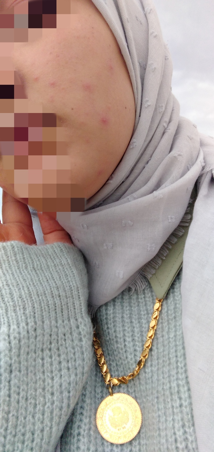 Yüzümün her tarafı böyle ve gittikçe artıyor neden böyle oldu bir anda hep bakım yapardım sivilce bile çıkmazdı noldu böyle