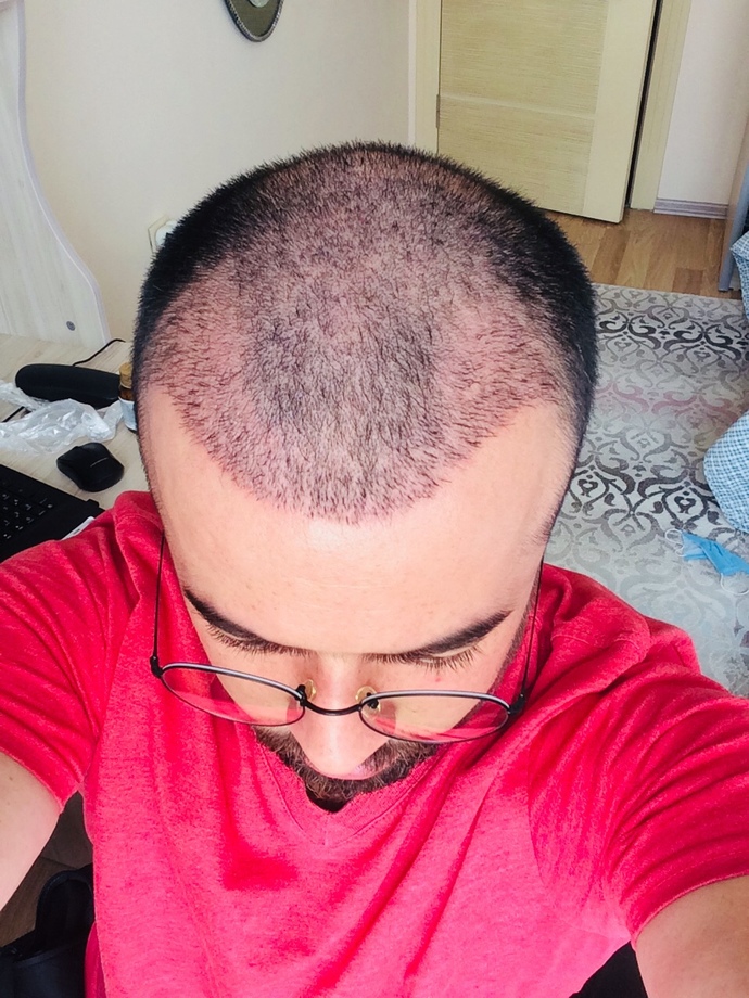 Saç ektirdim, ekim sonrası saçlarıma nasıl bakım uygulamalıyım?