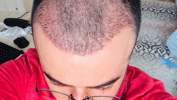 Saç ektirdim, ekim sonrası saçlarıma nasıl bakım uygulamalıyım?