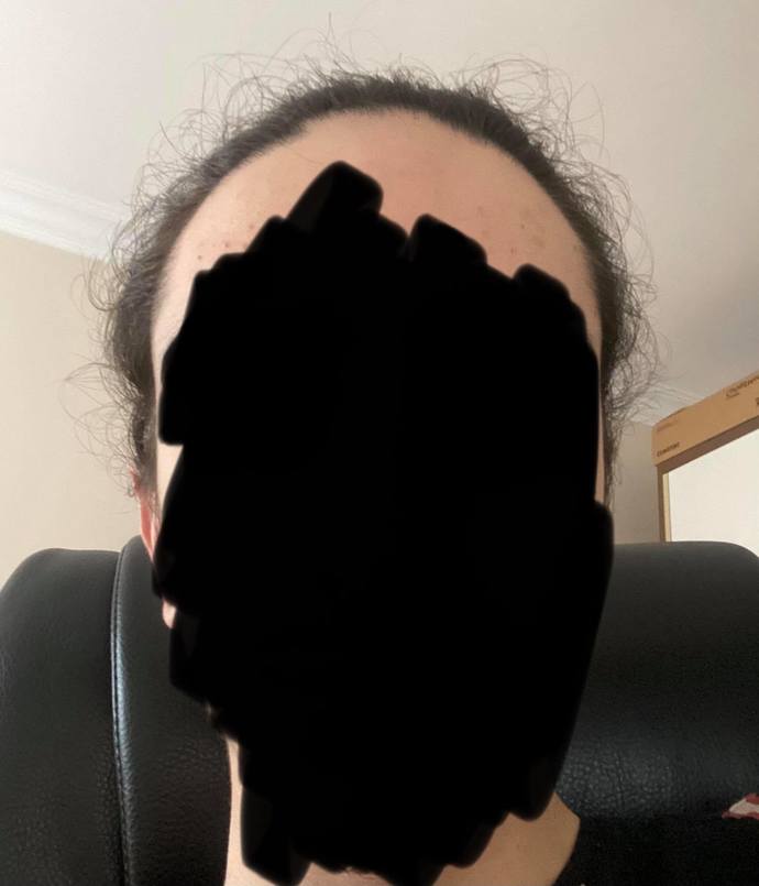 Saçımı uzatıyorum fakat aralardan küçük saçlar çıkıyor, ne yapmalıyım?