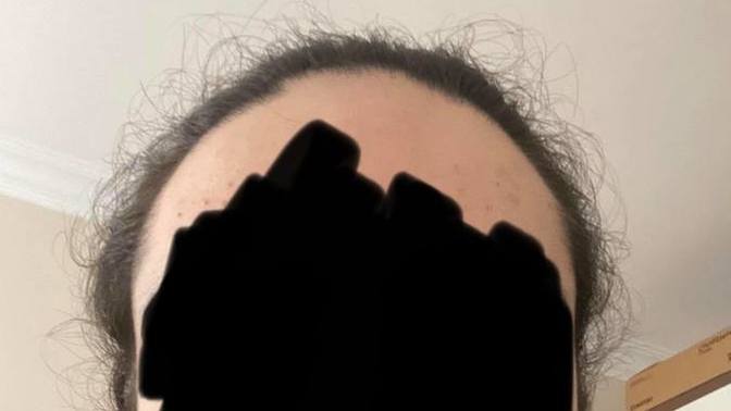 Saçımı uzatıyorum fakat aralardan küçük saçlar çıkıyor, ne yapmalıyım?