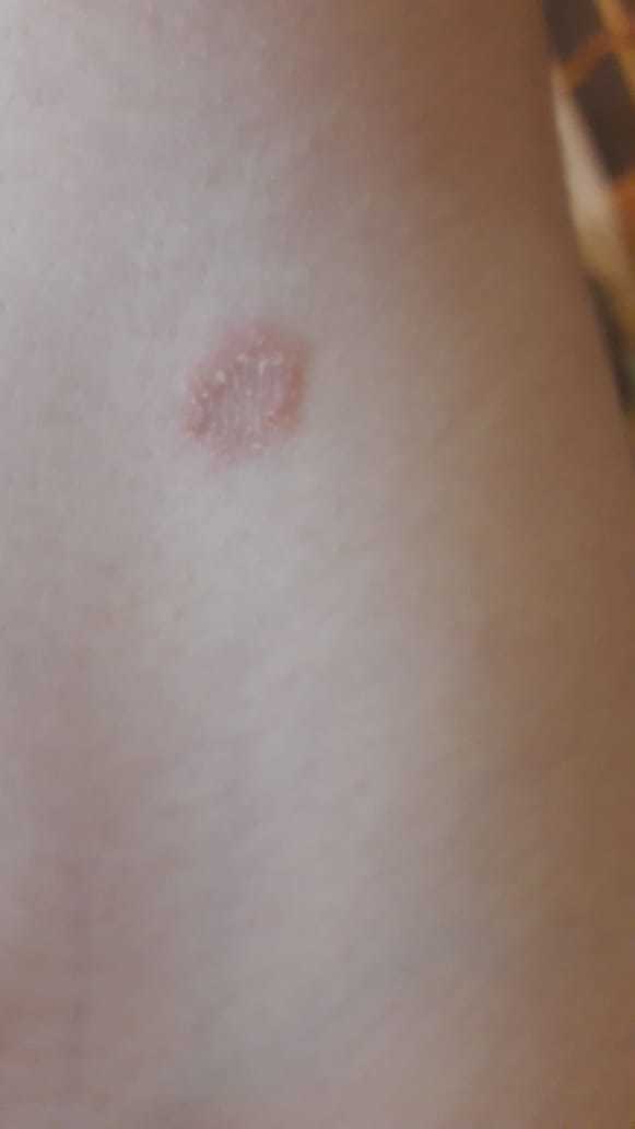 Tinea Corporis hastaligina yakalandim?