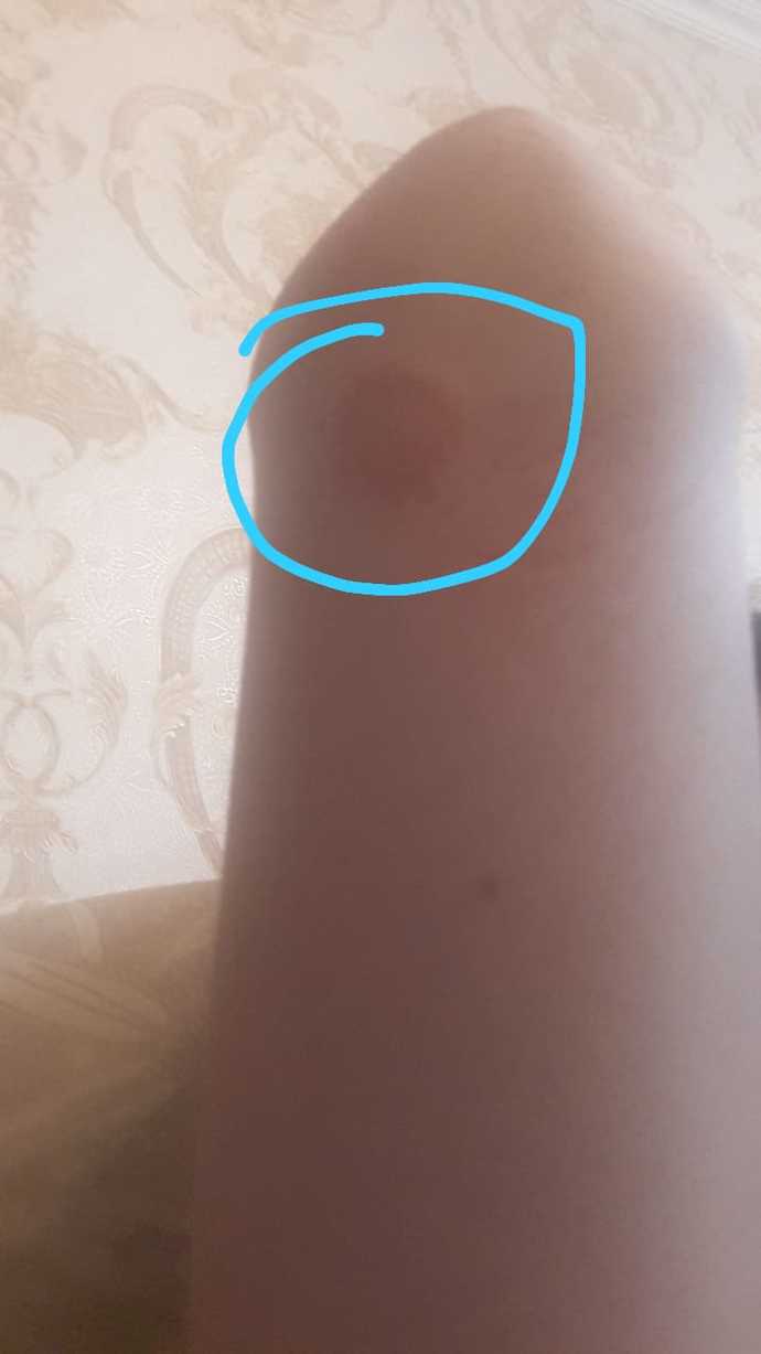 Tinea Corporis hastaligina yakalandim?