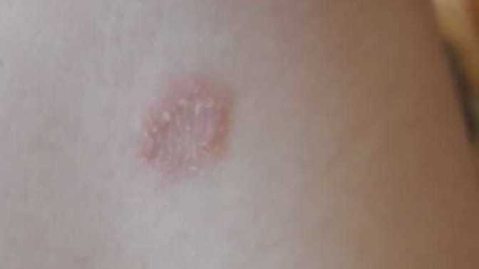 Tinea Corporis hastaligina yakalandim?