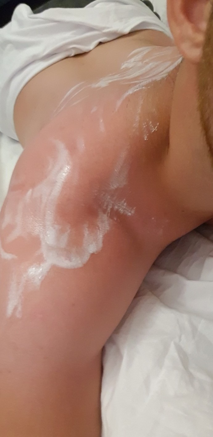 Güneş yanığına ne iyi gelir 🥺🥺?
