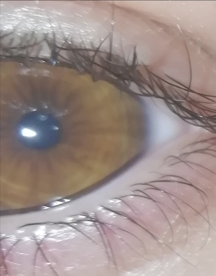 Güzel gözlere sahip olabilmek için renkli göz ameliyatı olsam mı?