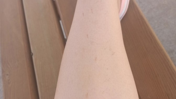 Lazer epilasyon yanığı nasıl geçer?