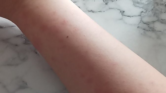 Kolumdaki bu kızarıklıklara ne iyi gelir?