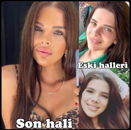 Sihirli Annemin Tuğçesi Damla Ersubaşı geçirdiği bir dizi estetik operasyonu sonrası fotoğrafını paylaştı! Estetikli halı nasıl?
