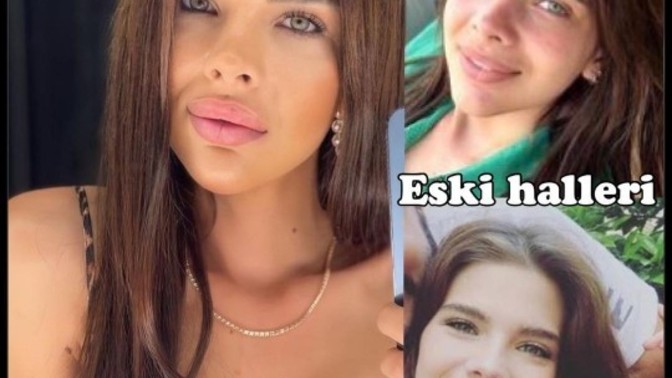 Sihirli Annem'in Tuğçe'si Damla Ersubaşı geçirdiği bir dizi estetik operasyonu sonrası fotoğrafını paylaştı! Estetikli halı nasıl?