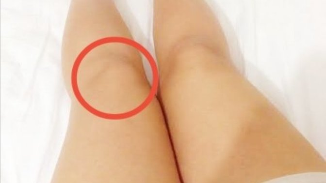 Resimde ki kısma aniden ağrı girdi, 1 haftadır geçmedi. Dizimi açıp kapatamıyorum çok ağrıyor. Sizce sebebi nedir😔❤️?