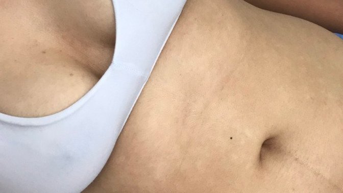 Göbeğimde böyle beyaz gibi noktacıklar var. Bu ne oluyor, vitiligo böyle mi oluyor?