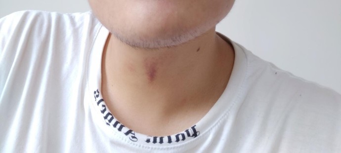 Boyundaki morluk emme izi gibi durmuyo mu?