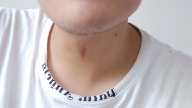 Boyundaki morluk emme izi gibi durmuyo mu?