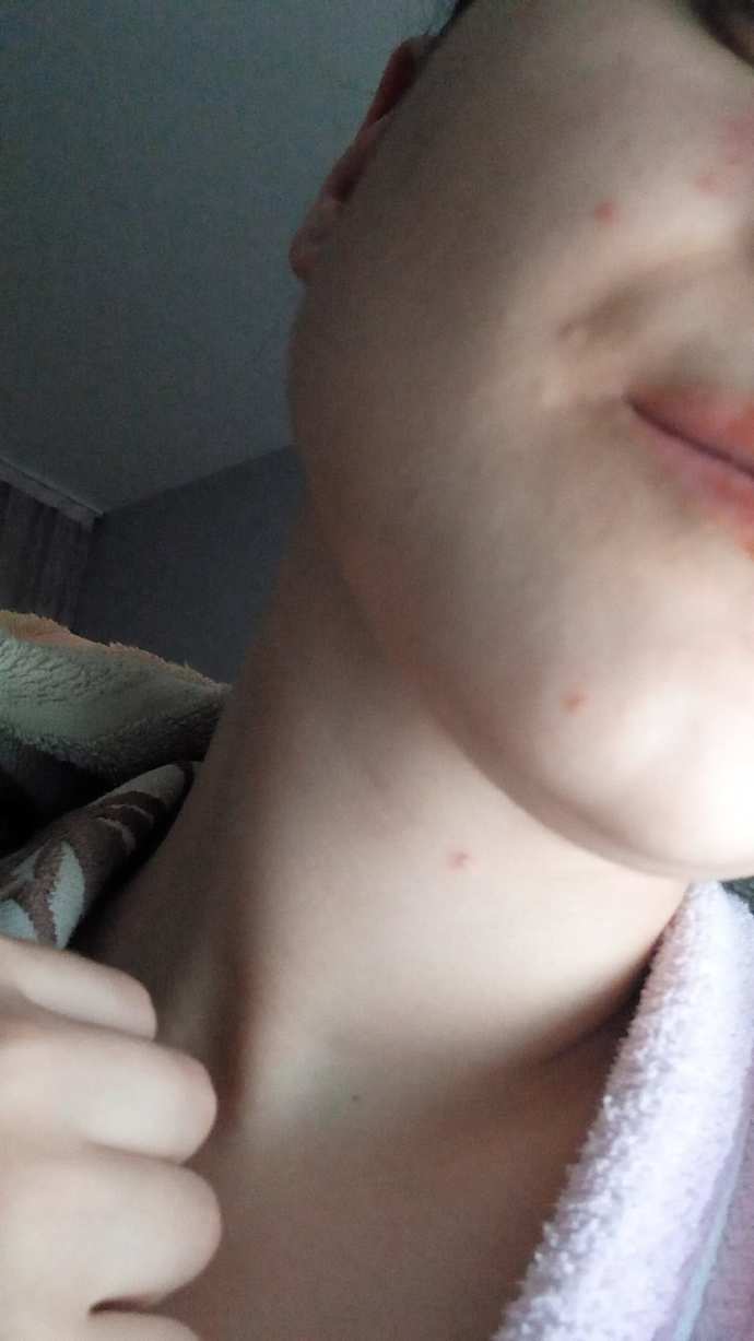 Alerji mi olmuşum, sıcaktan çıkar mı böyle?