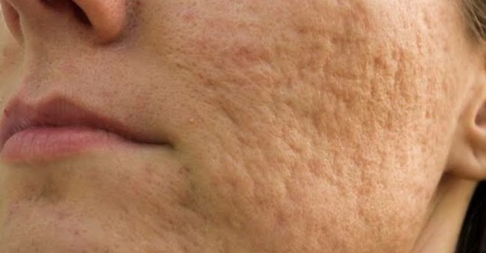 Sivilce izlerini, çukurlarını gideren bir krem var mı?