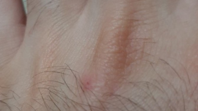Kedi tırmaladı bir şey olur mu?