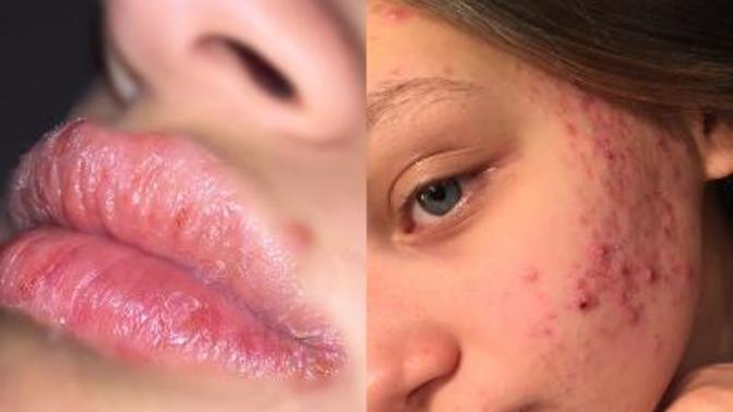 Kızım roaccutane kullanmasına rağmen hala sivilceleniyor ve izleri kaldı. Ne kullansak izleri yok ederiz?