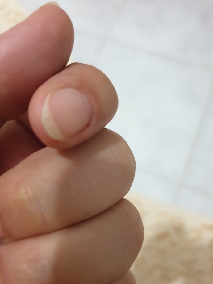 Tırnak Altı Boşluğu Diye Bir Sorun mu Varmış?