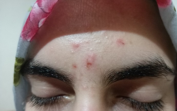 Sivilce izlerim ne hale geldi? Acil bakar mısınız?