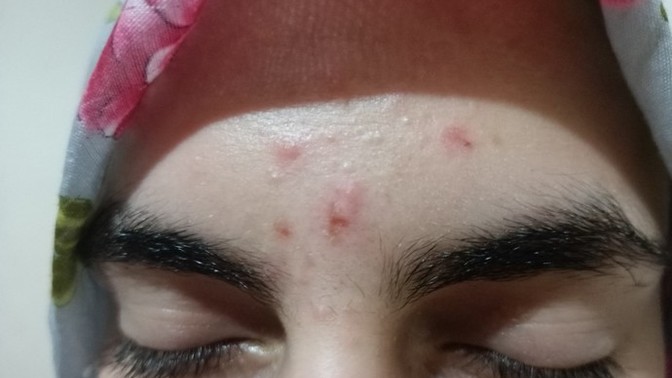 Sivilce izlerim ne hale geldi? Acil bakar mısınız?