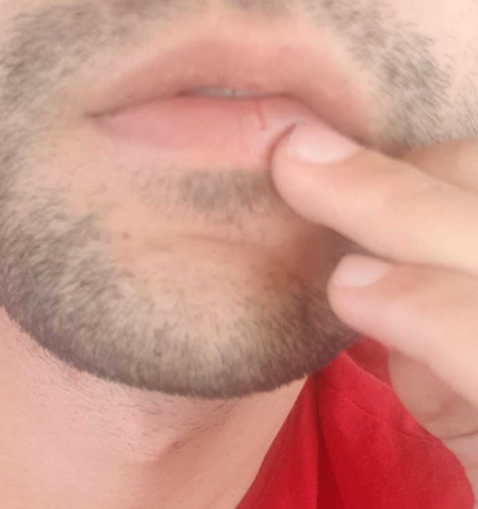 Dudak çatlamasının sebepleri nelerdir?