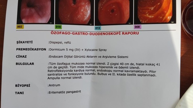 Arkadaşlar, reflü den falan anlayan bi doktor arkadaşlar varsa bana bu endoskopi sonucunu açıklayabilir mi?