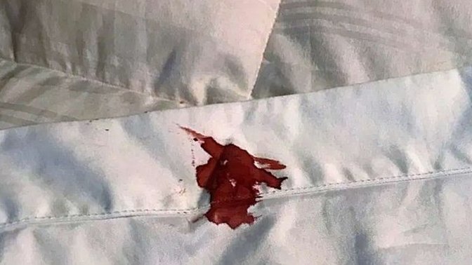 Çamaşırlardaki kan lekesi nasıl çıkar?