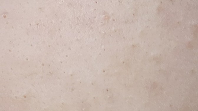 Gözenek mi siyah nokta mı?