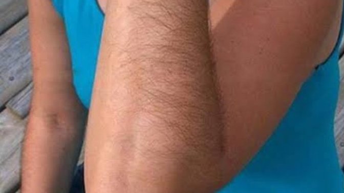 Kızlar, Bazı kadınlarda kıl problemı?
