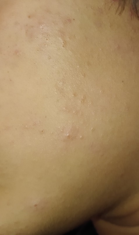Yüzde pötür pötür sivilce benzeri şeyler nasıl geçer?