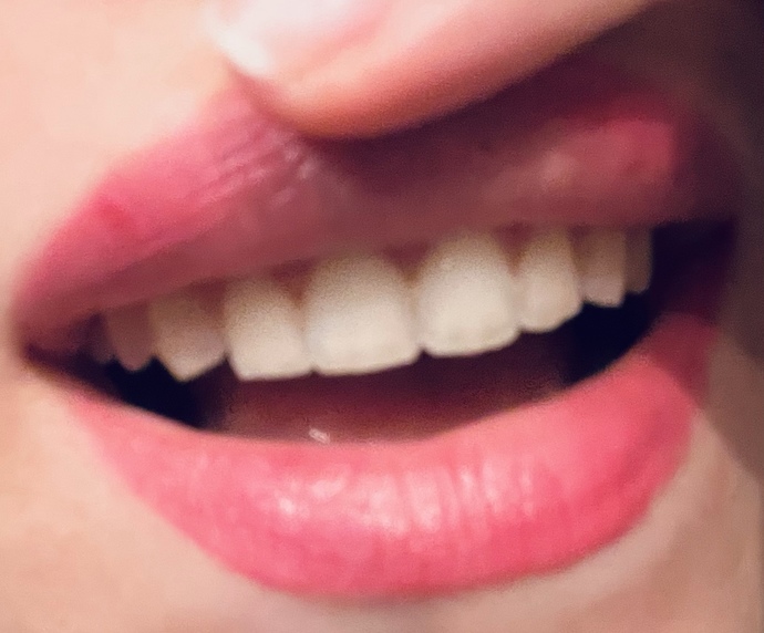 Diş teli tedavim sona erdi! Sizce sonuç nasıl olmuş?🥰?