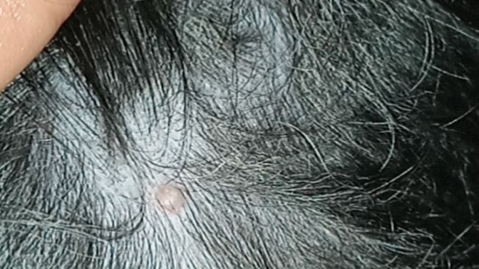 Köpeğimin sırtında sivilce gibi bir şey var, ne olabilir bu?