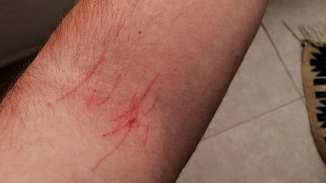 Sabah uyandığımda kolum derinden tırmalanmıştı. Bunu kim yapmış olabilir?