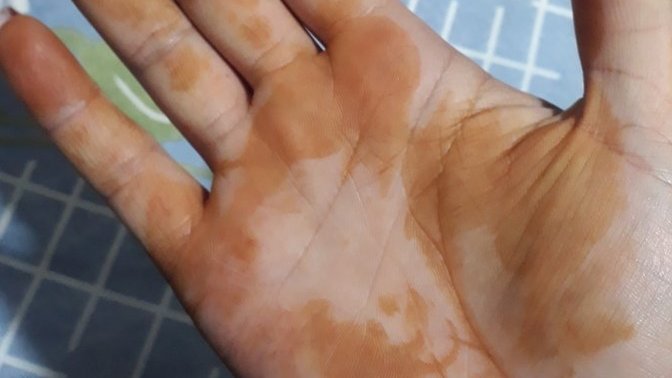 Ne bu, elde kına neden olur?